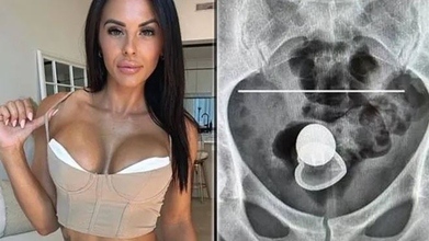 La actriz porno Alicia Davis fue operada tras perder un tapón anal ...